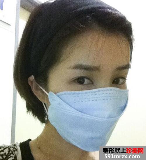 自体脂肪填充额头+硅胶假体隆鼻手术前后效果对比图和恢复过程