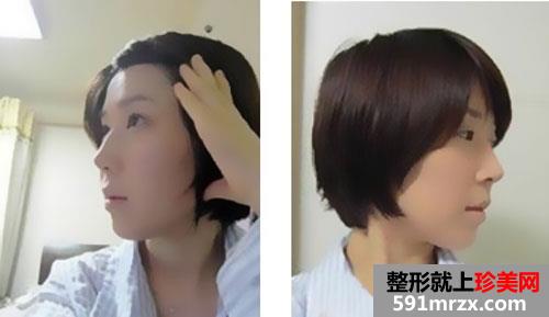 自体脂肪填充额头+硅胶假体隆鼻手术前后效果对比图和恢复过程
