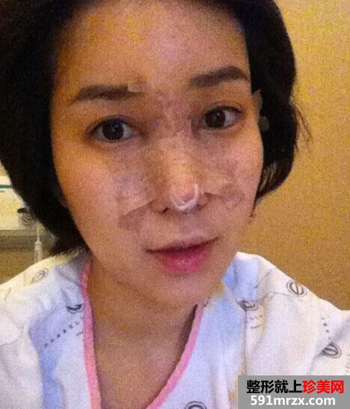 自体脂肪填充额头+硅胶假体隆鼻手术前后效果对比图和恢复过程