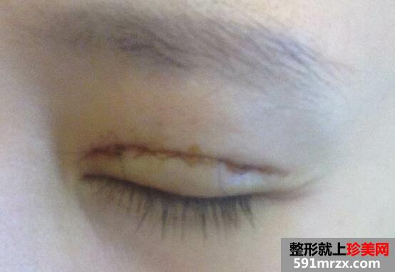 双眼皮术后4个月恢复不错了 分享给大家