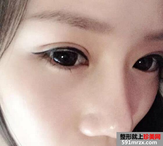 双眼皮术后4个月恢复不错了 分享给大家