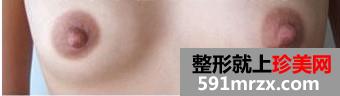 乳头缩小术 做一个更加自信的女人