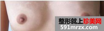 乳头缩小术 做一个更加自信的女人