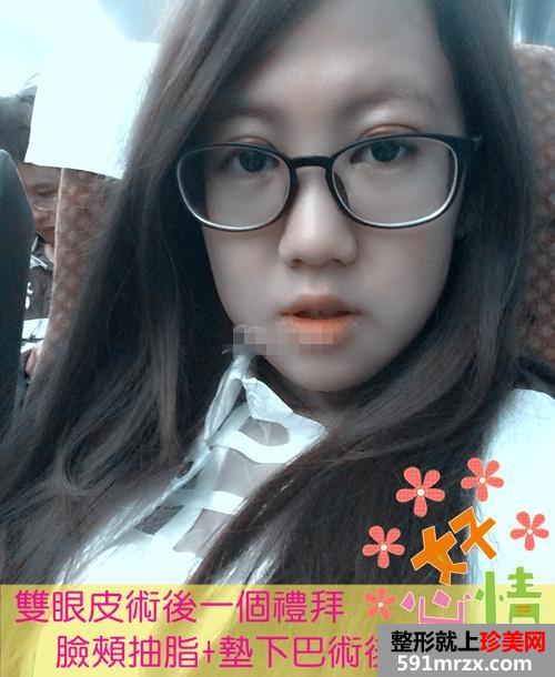 双眼皮修复手术+自体脂肪垫下巴 现在的我是不是更有魅力了