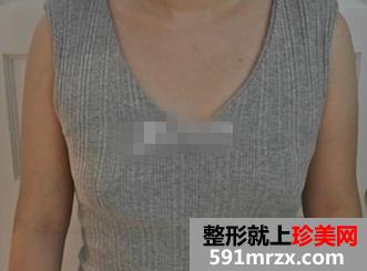矫正乳房下垂术 更年轻更挺拔