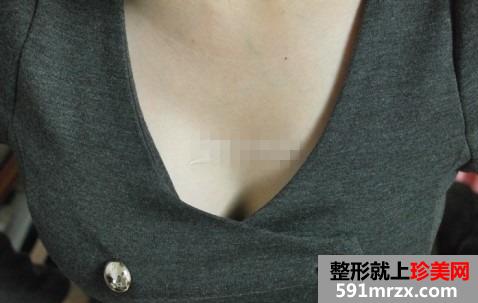 矫正乳房下垂术 更年轻更挺拔