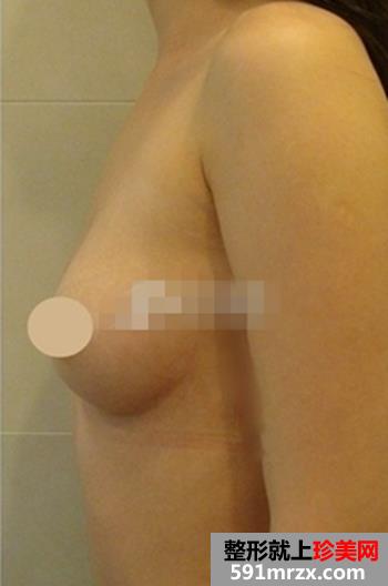 硅胶假体隆胸手术 我要当我自己的女王