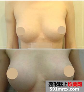 硅胶假体隆胸手术 我要当我自己的女王