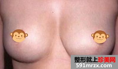巨乳缩小术 再也没有大胸的烦恼