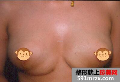 巨乳缩小术 再也没有大胸的烦恼