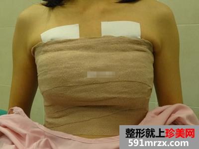 自体脂肪移植隆胸术 勾勒完美胸部曲线