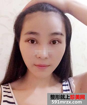 开眼角前后对比照片 向女神又迈进了一步
