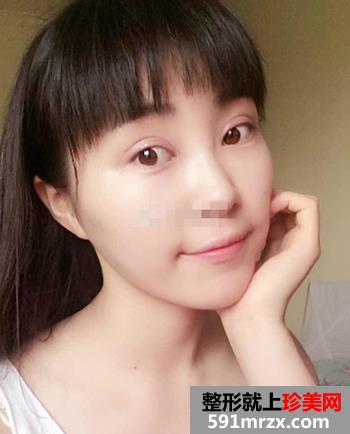 开眼角前后对比照片 向女神又迈进了一步