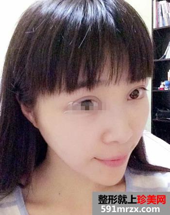 开眼角前后对比照片 向女神又迈进了一步