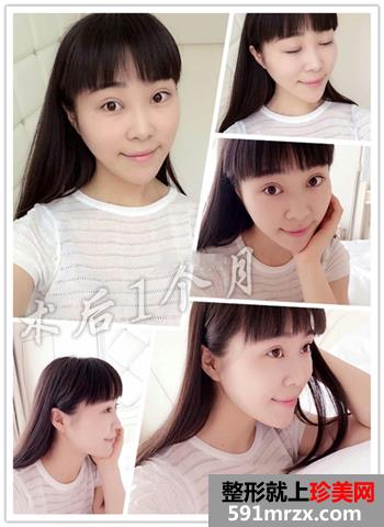 开眼角前后对比照片 向女神又迈进了一步