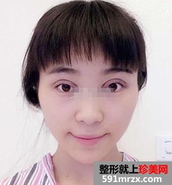 开眼角前后对比照片 向女神又迈进了一步