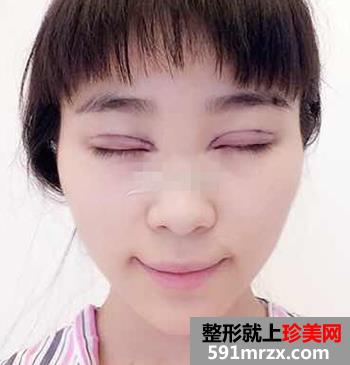 开眼角前后对比照片 向女神又迈进了一步
