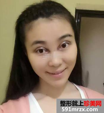 开眼角前后对比照片 向女神又迈进了一步