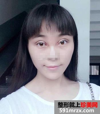 开眼角前后对比照片 向女神又迈进了一步