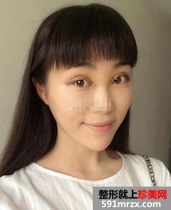 开眼角前后对比照片 向女神又迈进了一步