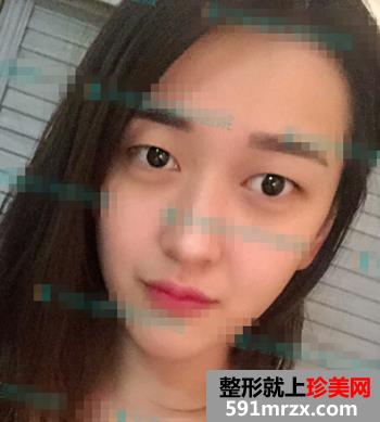 欧式双眼皮+无痕开眼角整形麻辣日记