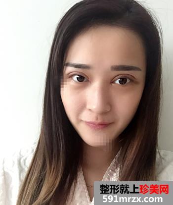 欧式双眼皮+无痕开眼角整形麻辣日记