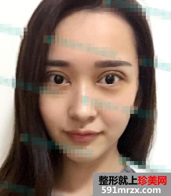欧式双眼皮+无痕开眼角整形麻辣日记