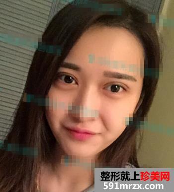 欧式双眼皮+无痕开眼角整形麻辣日记