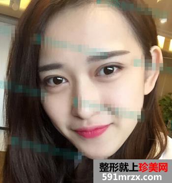 欧式双眼皮+无痕开眼角整形麻辣日记