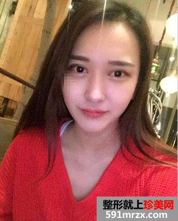 欧式双眼皮+无痕开眼角整形麻辣日记