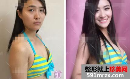 郑州90后瑜伽老师无痕丰胸手术一周后做了什么