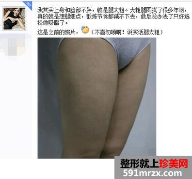做了大腿吸脂手术 三个月瘦了八公分