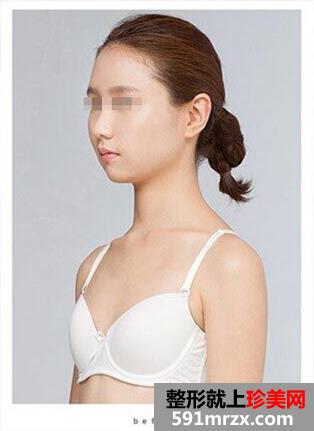 水滴假体隆胸 做一个敢于追求幸福的女人