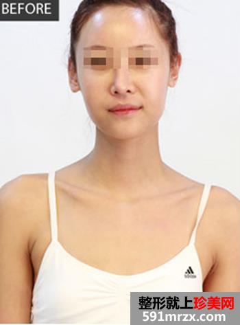 通过妙桃琴面假体隆胸手术 让我从A杯成功逆袭到C杯