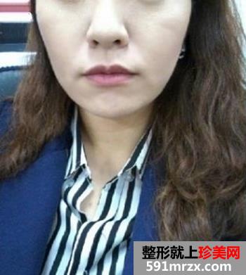 做了像素射频除皱 一下年轻了很多