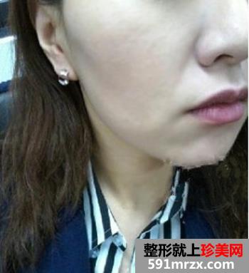 做了像素射频除皱 一下年轻了很多