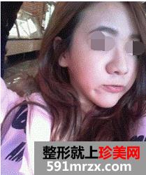 　　硅胶隆鼻手术+耳软骨垫鼻尖+缩鼻翼 现在的我自信多了。开始这个悲催的话题需要定的勇气…怎么说呢?额，其实这篇帖子是我做硅胶隆鼻手术+耳软骨垫鼻尖+缩鼻翼半年时间的记录帖子。  　　手术前不敢照镜子，特别是鼻子、我自己觉得很难看的!我给你们发几张以前的照片：    　　是不是鼻子特不好看呀? 鼻翼大、鼻头那么圆、还有鼻梁超低  　　下面让你们看下我从手术室出来在病房就照的张照片：  这篇帖子是我硅胶隆鼻+鼻尖软骨+鼻翼缩小+吸脂半年时间的记录帖子。  　　怎么样? 鼻子是不是有很明显的变化呀!嘻嘻  　　再来上张拆线后恢复期间的照片：  贴吧分享：郑州硅胶隆鼻+鼻尖软骨+鼻翼缩半年啦!  　　下面再来基本恢复的照片  贴吧分享：郑州硅胶隆鼻+鼻尖软骨+鼻翼缩半年啦!  　　鼻子变高了，脸部也有立体感了，皮肤也变好了~  　　现在不打扮也好漂亮的!哈哈  　　朋友们也都羡慕我的变化的～呵呵  贴吧分享：郑州硅胶隆鼻+鼻尖软骨+鼻翼缩半年啦!  　　这是我现在的面貌，看起来怎么样呢?漂亮吗?  　　以上内容就是对做了手臂吸脂3个月了 减肥到25cm了的介绍，希望对你有所帮助。若有疑问或想了解更多整形美容方面的信息，欢迎咨询我们的在线专家，他们将为你提供最优质的服务。