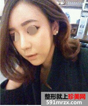 硅胶隆鼻手术+耳软骨垫鼻尖+缩鼻翼 现在的我自信多了