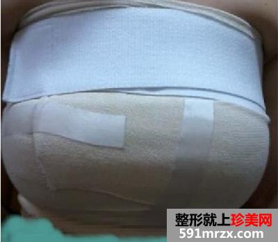 假体丰胸手术恢复全过程 看37岁的妈妈如何逆袭成少女