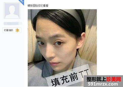 做了脸部自体脂肪填充 现在照相非常上镜