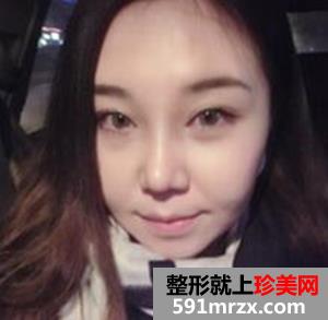 面部吸脂减肥 朋友不再叫我胖子脸
