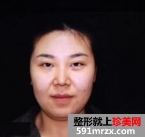 面部吸脂减肥 朋友不再叫我胖子脸