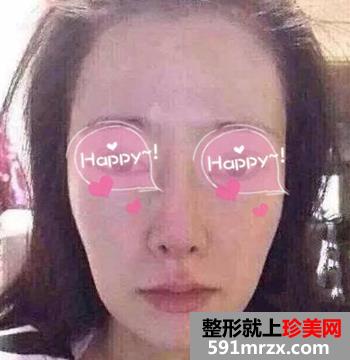 在上海做的自体脂肪填充眼窝+面颊 变美了吗