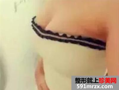 曼托假体隆胸5个月了 我是公认的美女大小姐