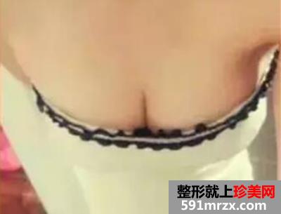 曼托假体隆胸5个月了 我是公认的美女大小姐