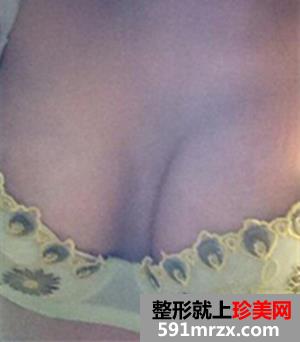 感谢es假体隆胸 让我拥有迷人乳沟