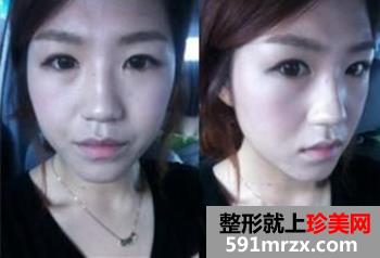 北京做的鼻部整形+自体脂肪移植丰脸手术 丑女大翻身