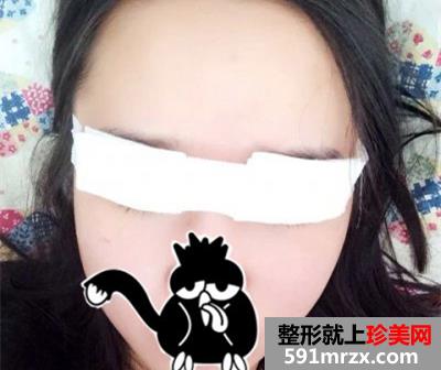 埋线法双眼皮