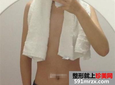新维度自体脂肪隆胸,北京自体脂肪隆胸术