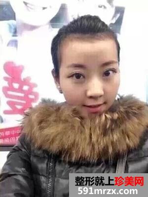 像素激光祛痘印